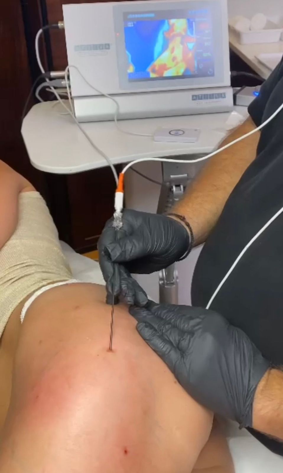 ATTIVA® Radiofrequenz-Lifting
