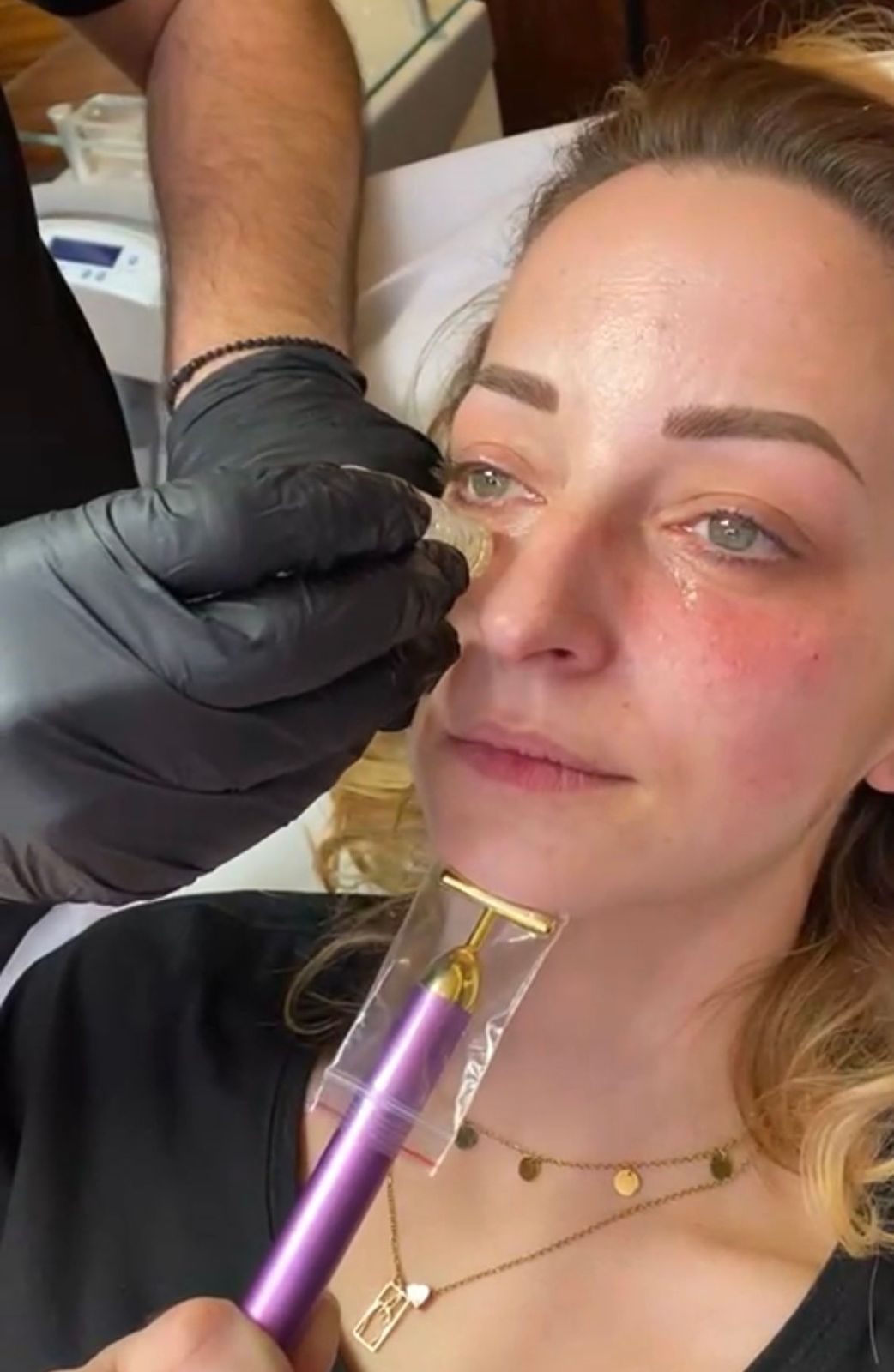 Mesotherapie & Microneedling